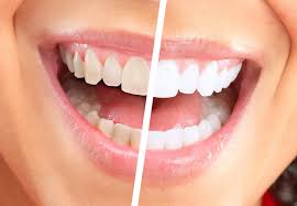 Snowhite Teeth Whitening - blanchissement dentaire – en pharmacie – action – site officiel